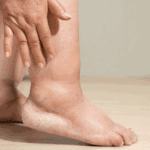 Помалку познат симптом на срцеви заболувања